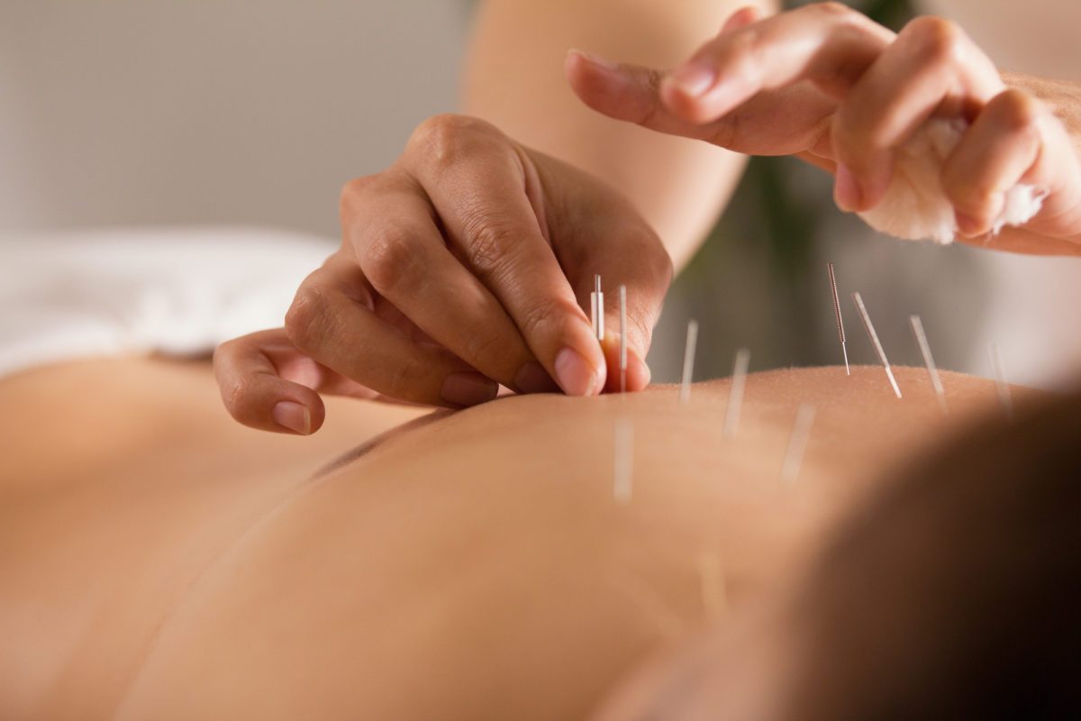 The doctor sticks needles into the girl’s body on the acupuncture – close up